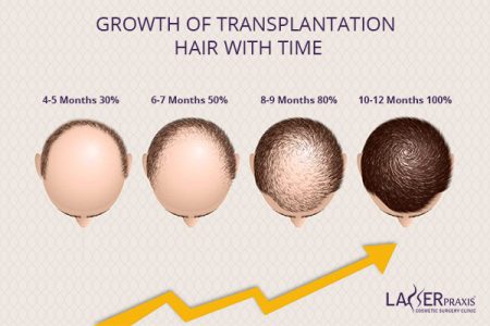 GROWTH-OF-TRANSPLANTATION-HAIR-WITH-TIME GROWTH-OF-TRANSPLANTATION-HAIR-WITH-TIME