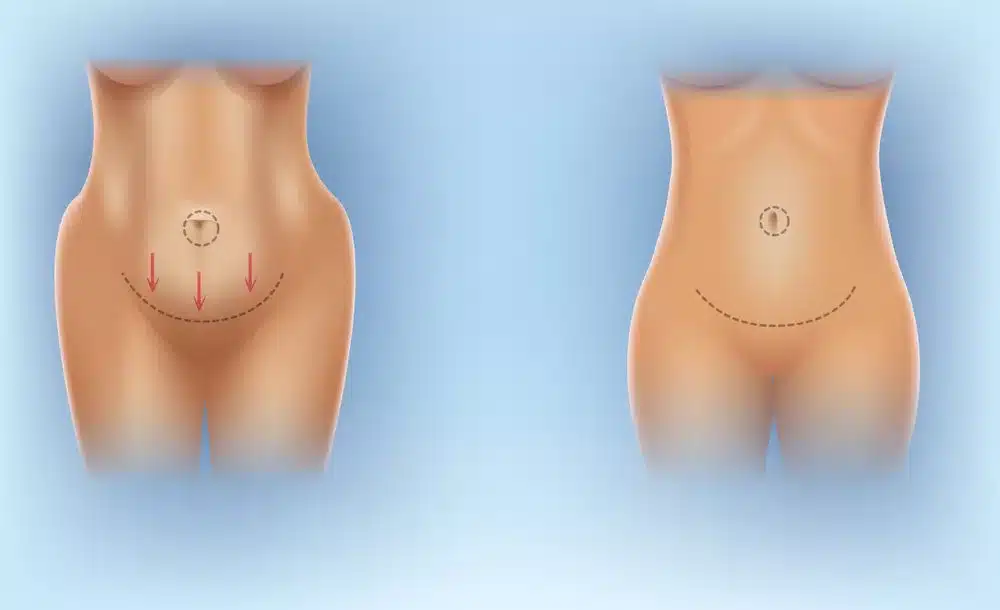 Discover-the-Cost-of-a-Mommy-Makeover-jpg